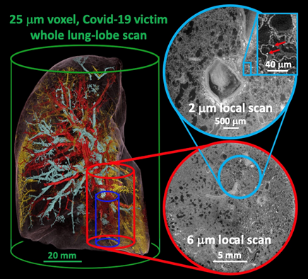 Scan of Covid victim's lungs